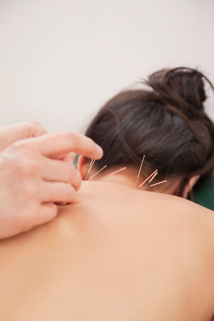 Acupuntura